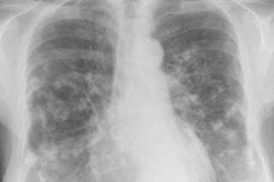 New Jersey Mesothelioma Attorneys Explain Symptoms and Cancer Diagnosis.