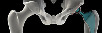 Photo of Stryker Hip replacement