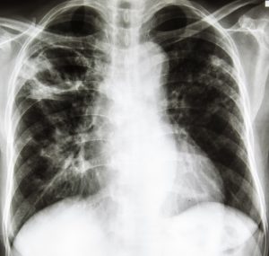 Call us to learn about mesothelioma lawsuit compensation.
