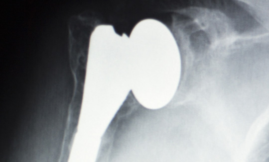 Photo of Shoulder Implants Xray
