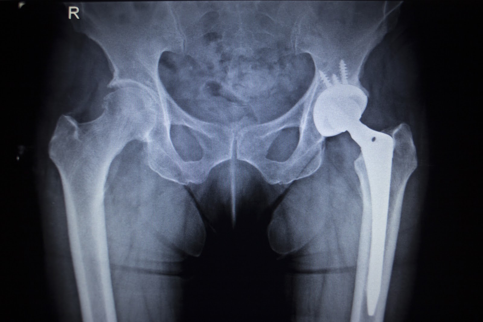 Hip Implant Injury Attorney NJ